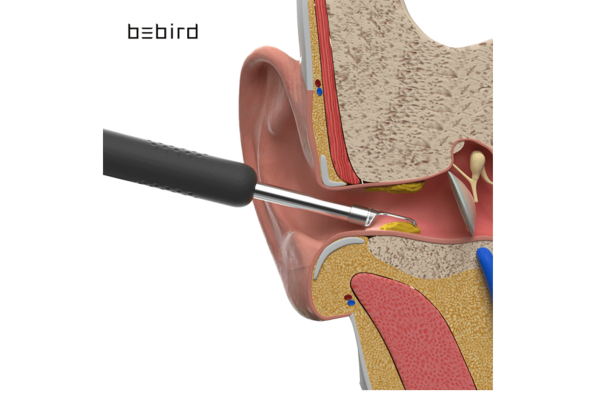 Средство для удаления ушной серы Bebird R1